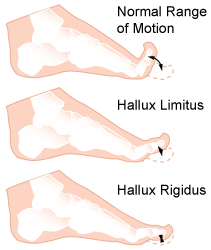 Hallux Limitus / Hallux Rigid (Osteoarthritis of the 1st toe)