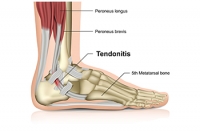 Causes of an Achilles Tendon Injury