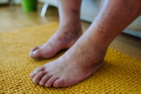 Tips for Diabetic Foot Care