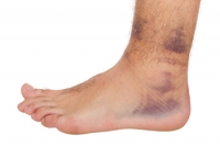Definition and Symptoms of Ankle Sprains