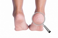 Cracked Heels Begin with Dry Skin