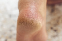 Definition and Risk Factors of Cracked Heels