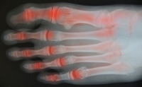 Arthritis of the Feet