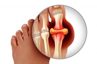 Gout Causes and Treatments