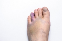 Causes and Treatments of Broken Toes
