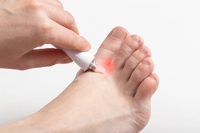 Symptoms and Causes of Athlete’s Foot